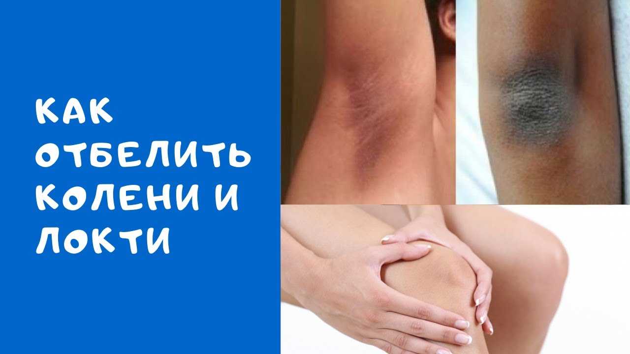 Как отбелить колени и избавиться от темных пятен навсегда