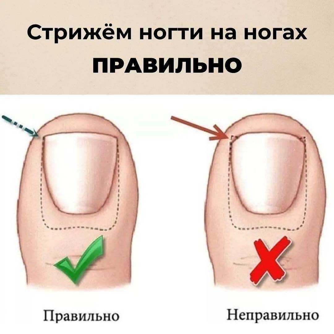 Как правильно стричь ногти на ногах: полезные советы
