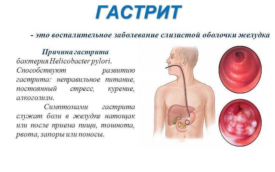 Психосоматика и желудок: о чем сигнализируют болезни жкт?