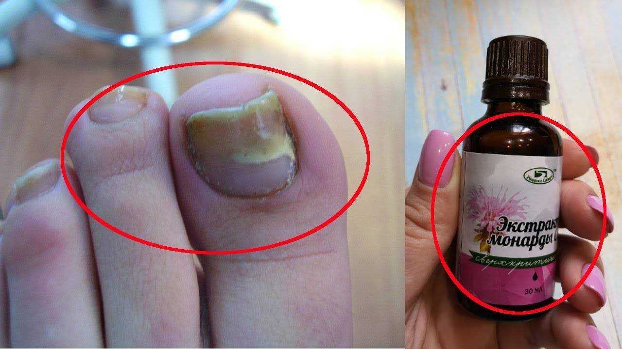 Масло чайного дерева от перхоти