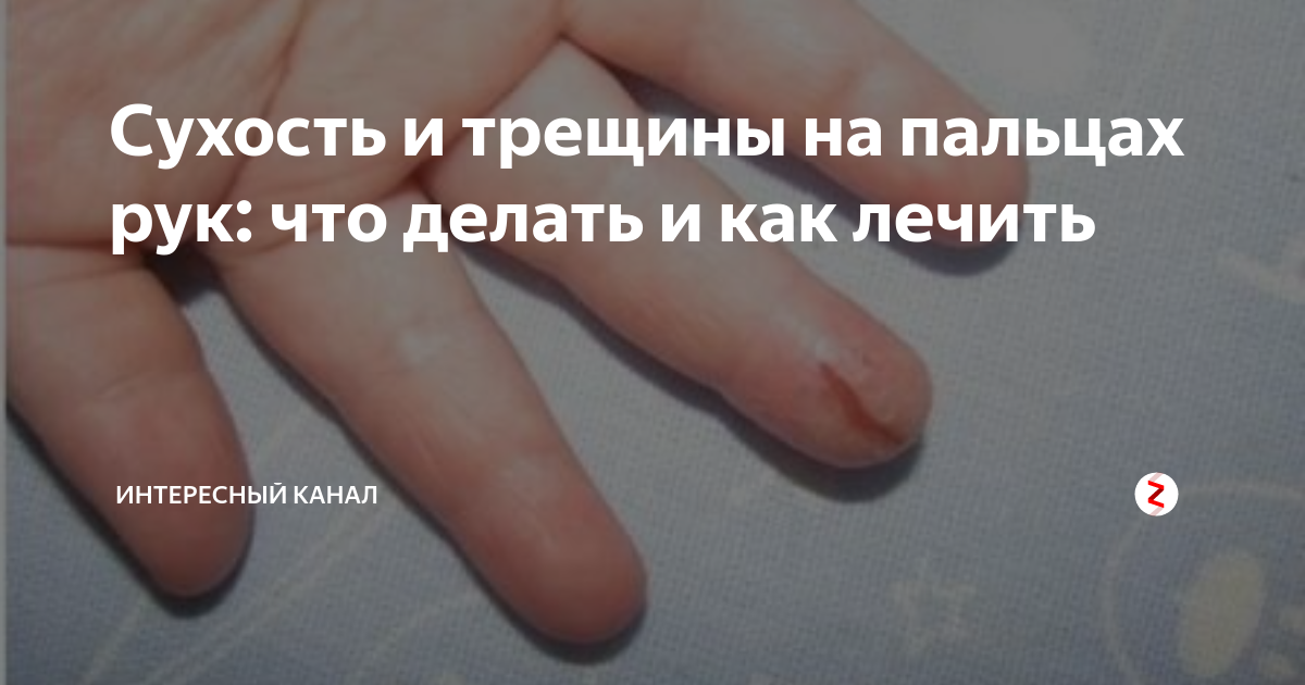 Рассказываем почему кожа на пальцах рук трескается сохнет и лопается до крови