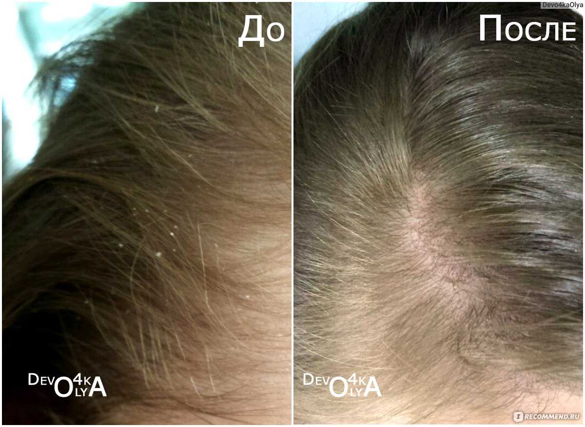 Дегтярное мыло - свойства, область применения и противопоказания. воздействие мыла дегтярного на кожу и волосы.