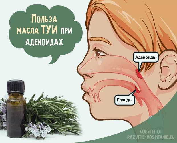 Масло туи при аденоидах для детей: схема лечения