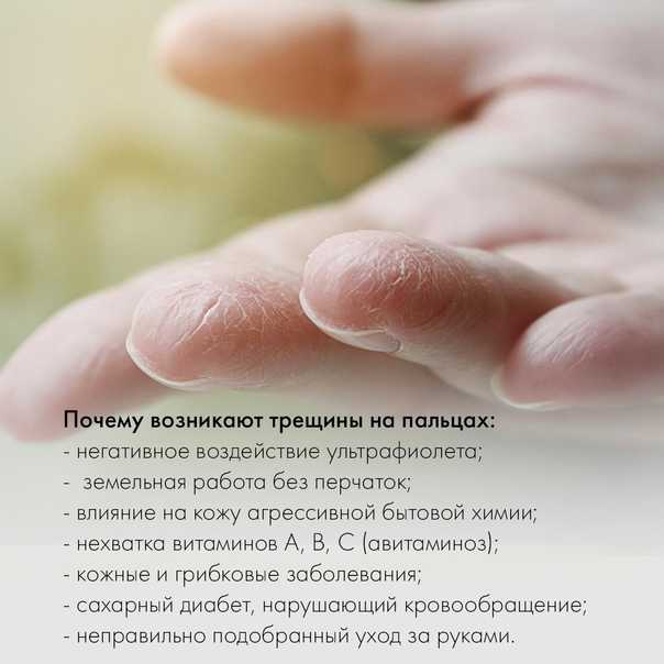 Почему трескаются пальцы на руках от холода зимой: сильные трещины от мороза, что делать, если потрескалась, сохнет и шелушится кожа до крови