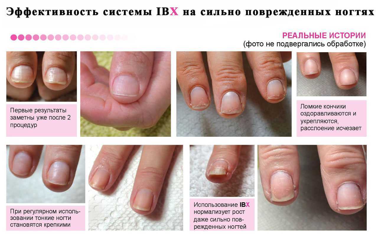 Как восстановить ногти после гель лака в домашних условиях: неправильное снятие