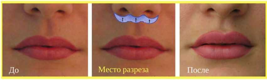 Операция булхорн, подтяжка губ bull horn, lip lift | 
										интернет-журнал estetmedicina.ru