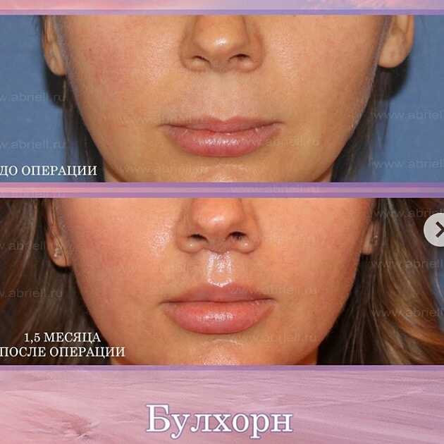 Операция булхорн, пластика верхней губы во владивостоке