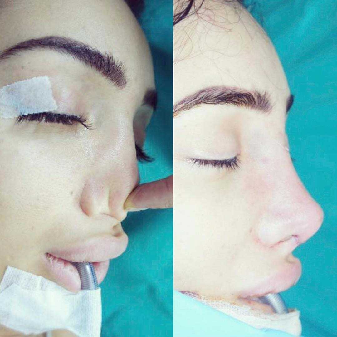 Самый популярный нос в instagram: что не нравится пластическому хирургу и почему